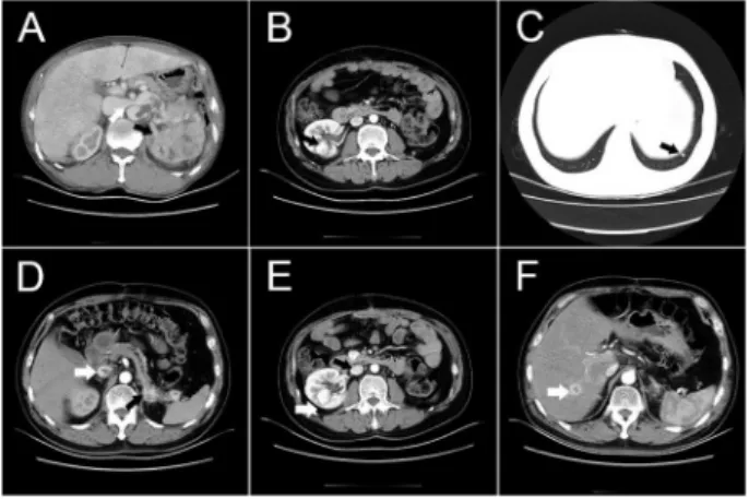 Figure 1. Computed tomography (CT) images of the patient with metastatic renal cell carcinoma at different time points