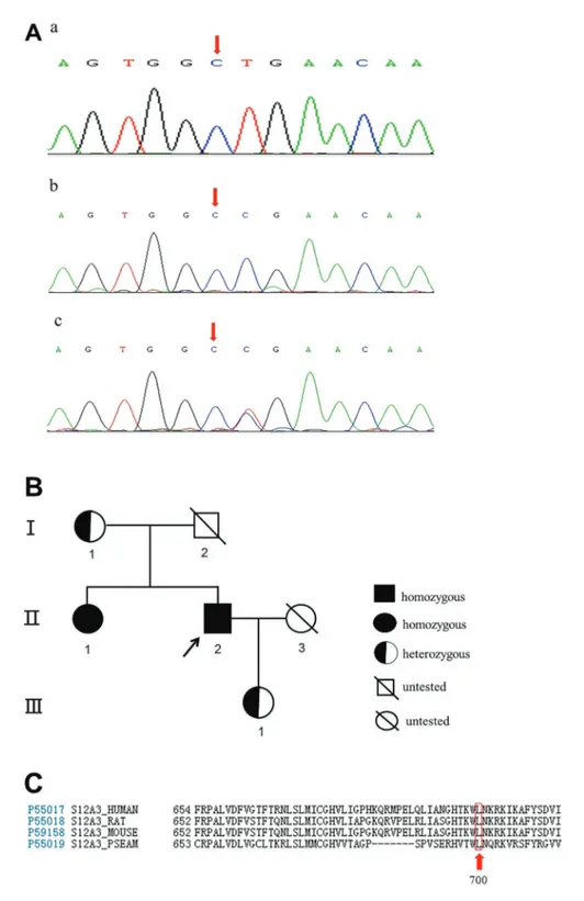 Figure 1. A, mRNA sequences diagram of mutant SLC12A3 gene in the studied pedigree: a, mRNA sequences of wild type; b, mRNA sequences of the patient’s mother and daughter, who have heterozygous mutations (in exon 17, c.2099T 4 C, CTG CCG, leading to Leu700