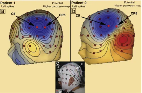 Fig. 1. Map of the electric potential of patients 1 (a) and 2 (b) on the highest value of the paroxysm at C 5 (left epileptiform EEG discharges)