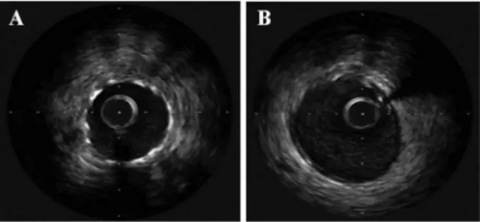 Figure 1. Intravascular ultrasound imaging of the stable (SAP) and unstable (UAP) angina pectoris groups