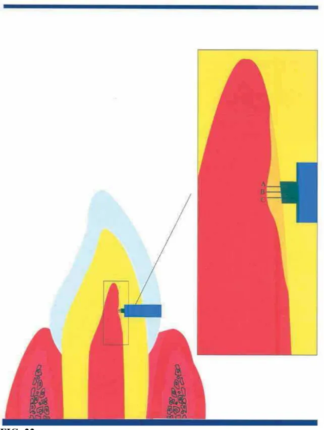 FIG. 22 Esquema mostrando a posição das 3 linhas imaginárias (A, B, C)  traçadas para medir a espessura da ponte de tecido duro.