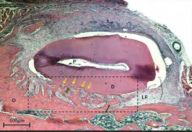 Fig 5.  Incisivo superior direito com anquilose dentoalveolar. Em destaque, a  formação de tecido ósseo em direção ao dente com início de reabsorção  por substituição  (setas amarelas)