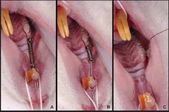 Fig 2.  Dispositivo para MDI do molar superior direito ancorado ao incisivo  superior direito