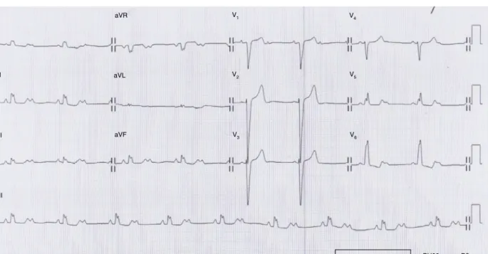 Figure 1 Electrocardiogram showing 2:1 atrioventricular block.