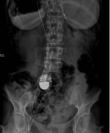 Figure 5 Abdominal-pelvic X-ray. DTO: right.