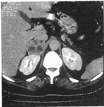 Fig. 1 TAC abdominal. Formação tumoral sólida localizada à glândula S.R. Dt2