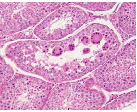 FIGURA 19B – Degeneração testicular acentuada. Células  multinucleadas “gigantes” no interior do túbulo seminífero  (HE, 200x)