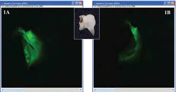 FIGURA 1 - IMAGENS OBTIDAS NO MICROSCÓPIO CONFOCAL ANTES (A) E APÓS (B)  A REMOÇÃO DO TECIDO CARIADO