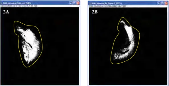 FIGURA 2 - ANÁLISE DAS IMAGENS NO SOFTWARE “IMAGE J” ANTES (A) E APÓS (B)  A REMOÇÃO DO TECIDO CARIADO