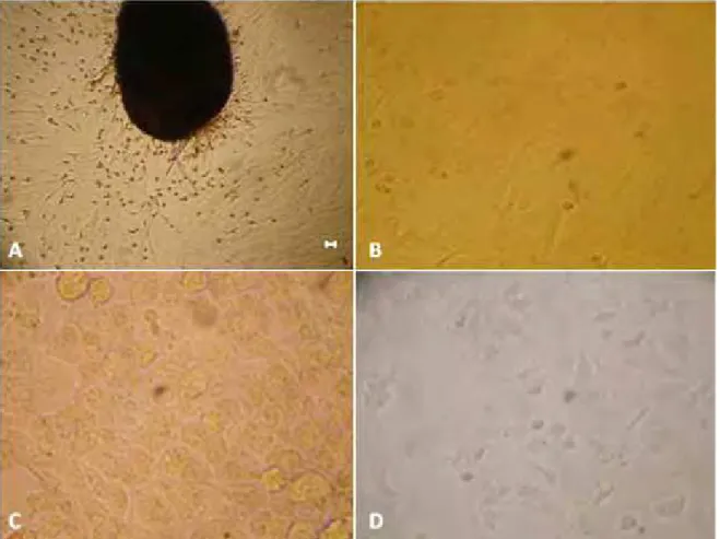 Figura 3: Fotomicrografia de cultivo primário de células tumorais de mama de cadela e  de cultivo celular das linhagens de câncer de mama MCF-7 e MDA-MB-23