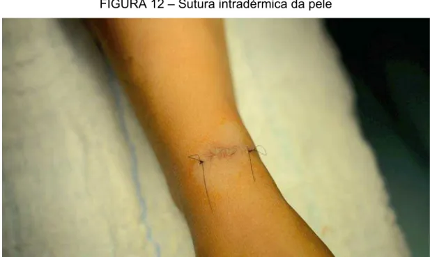 FIGURA 12 – Sutura intradérmica da pele 