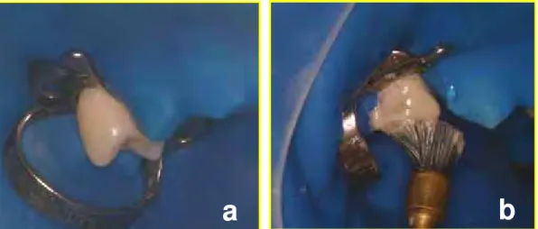 FIGURA 1 – Procedimentos pré-operatórios: a)Isolamento absoluto; b) Profilaxia  com pedra-pomes e água