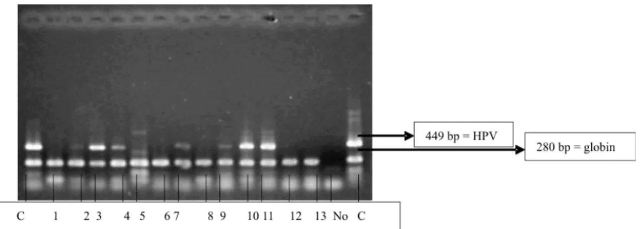Figure 1. Product of the amplification of the viral genome of HPV generated after PCR.