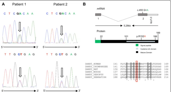 Fig. 1 a Forward and reverse DNA sequence chromatograms of patient 1 and 2 showing the c.455G > A allelic variant (highlighted by arrows ).