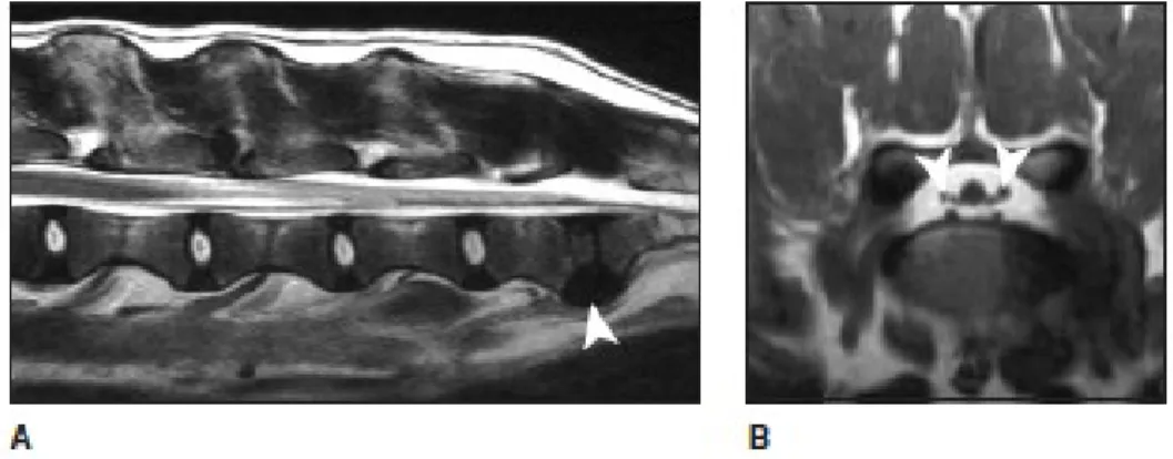 Figure 1 – Normal lumbosacral MRI. A) Sagittal, T2-weighted MRI of the lumbosacral spine in  extension