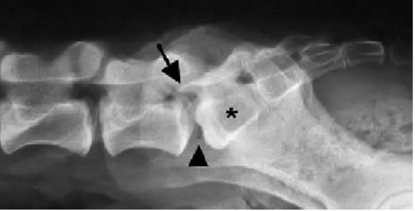 Figure  3  –  Lateral  radiograph  of  the  lumbosacral  region  of  a  dog.  Note  the  presence  of  a  transitional  vertebra  (asterisk),  elongation  of  the  sacral  lamina  into  the  caudal  aperture  of  L7  (arrow), and the vacuum phenomenon betw