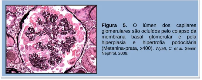 Figura  5.  O  lúmen  dos  capilares  glomerulares são ocluídos pelo colapso da  membrana  basal  glomerular  e  pela  hiperplasia  e  hipertrofia  podocitária  (Metanina-prata, x400)