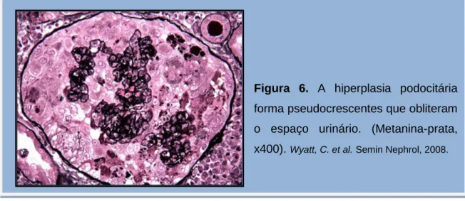 Figura  6.  A  hiperplasia  podocitária  forma pseudocrescentes que obliteram  o  espaço  urinário