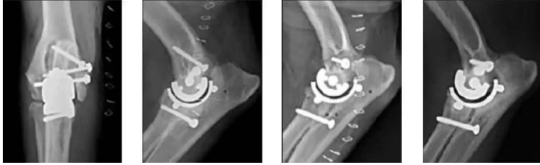 Figura  8  –  Esquerda:  Radiografias  pós  operatórias  apresentando  a  posição  correta  da  prótese  TATE