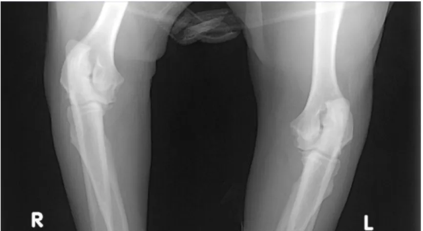 Figura 16 – Radiografias com projeção mediolateral em flexão a 90º do cotovelo, esquerdo invertido (L) e direito  (R),  de  um  cão  com  DPCM  unilateral