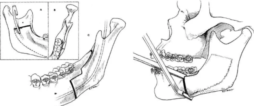 Figura 2  – Modificação do desenho da osteotomia sagital por Wolford 