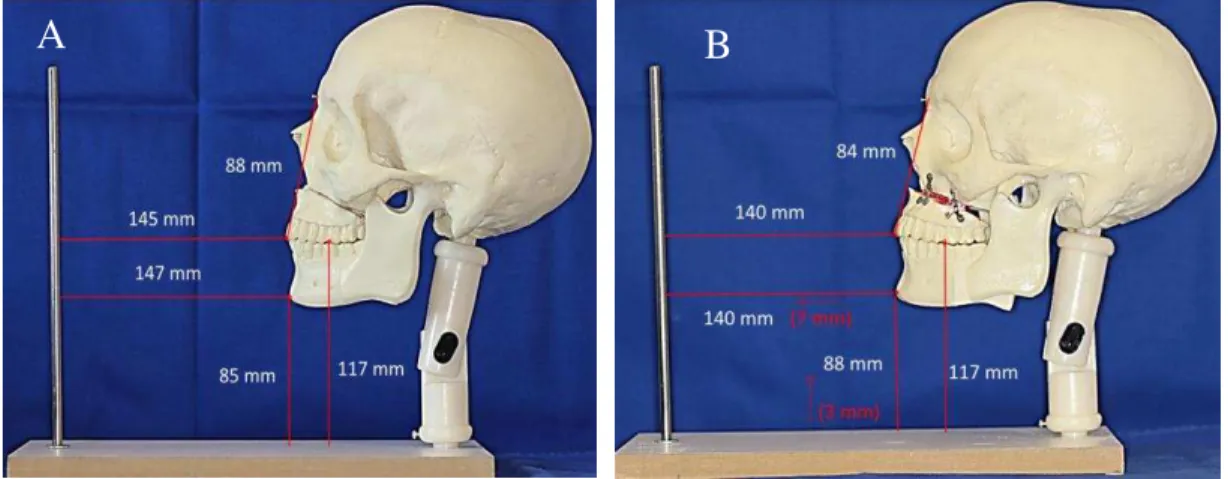 Figura 6 – Crânio (face total) instalado na base com haste vertical. (A) osteotomias Le Fort I e  Sagitais pré-realizadas; (B) Movimento com avanço e giro anti-horário do plano  oclusal