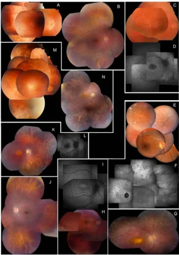 Figure 1. Clinical characteristics of eight LCA patients with an established molecular diagnosis, illustrating characteristic  phenotypic features associated with different genotypes