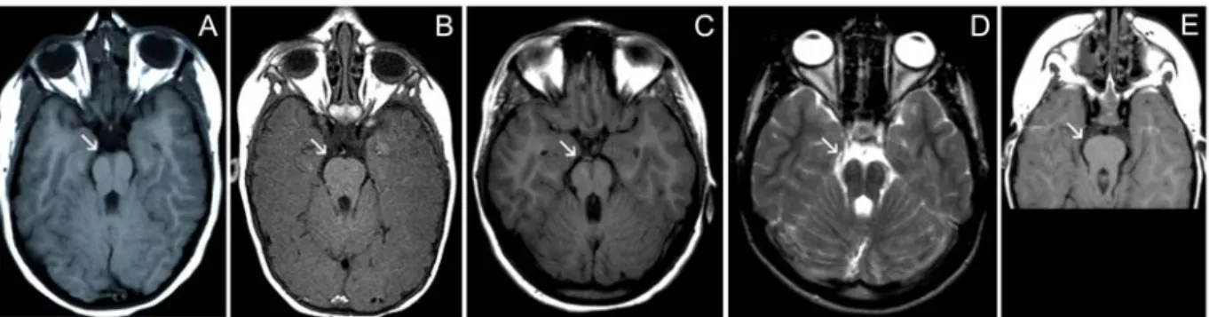Figure 2. Magnetic resonance imaging (MRI) showing characteristic molar tooth sign (MTS) in five patients with Joubert  syndrome/cerebello-oculo-renal syndrome due to mutations in CEP290 (all are axial sections through midbrain)