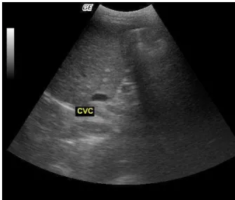 Figure  3a-  Transverse  ultrasound  image  of  the  CVC  (Caudal  vena  cava),  showing  the  oval  shape  of  the  vessel,  due  to  the  compression  of  the transducer in the abdominal wall