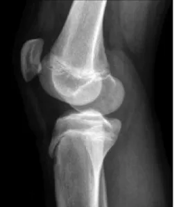 Figura 3. Radiografia em dois planos de um joelho, Osteocondrite dissecante (arquivo da autora)