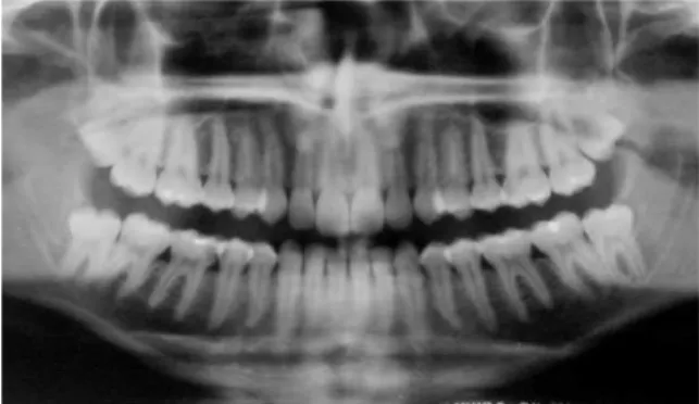 FIGURA 1 - Radiografia ortopantomográfica incluída no Grupo I (sem a  presença dos terceiros molares inferiores).