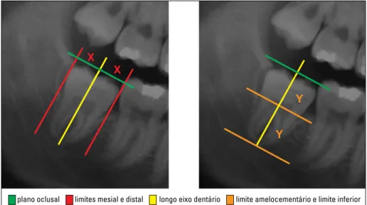 FIGURA 3 - Metodologia utilizada para seleção das radiografias com a presença dos terceiros molares inferiores  (Grupo II).