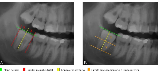 FIGURA 9 - Metodologia utilizada para seleção das radiografias com a presença dos  terceiros molares inferiores (Grupo II)