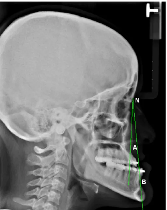 Figura 3- Ângulo ANB: indica a relação maxilo-mandíbular no sentido ântero-posterior. 