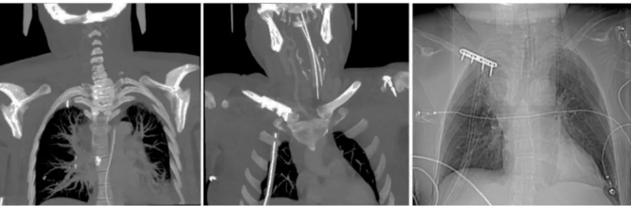 Figura 10 Imagens embolizac ¸ão aneurisma sacular vertebral com coils (Servic ¸o de Neurorradiologia H