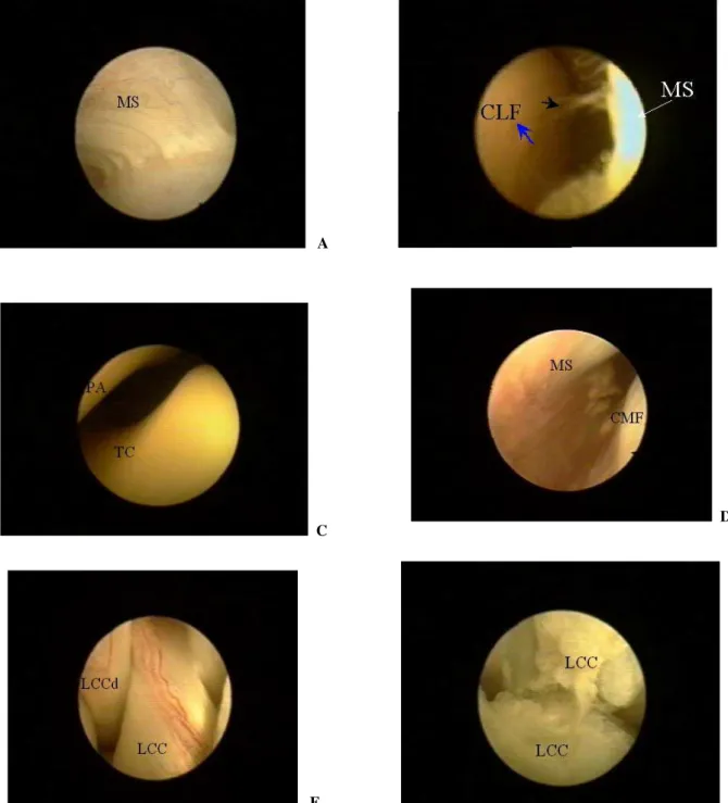 Figura 2. Fotografias das imagens artroscópicas da articulação fêmoro-tíbio-patelar de cães submetidos à secção experimental do LCCr  (dia zero) guiada por vídeo-artroscopia