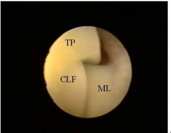 Figura 3. Fotografias das imagens artroscópicas da articulação fêmoro-tíbio-patelar de cães submetidos à secção experimental do  LCCr (dia zero) guiada por vídeo-artroscopia