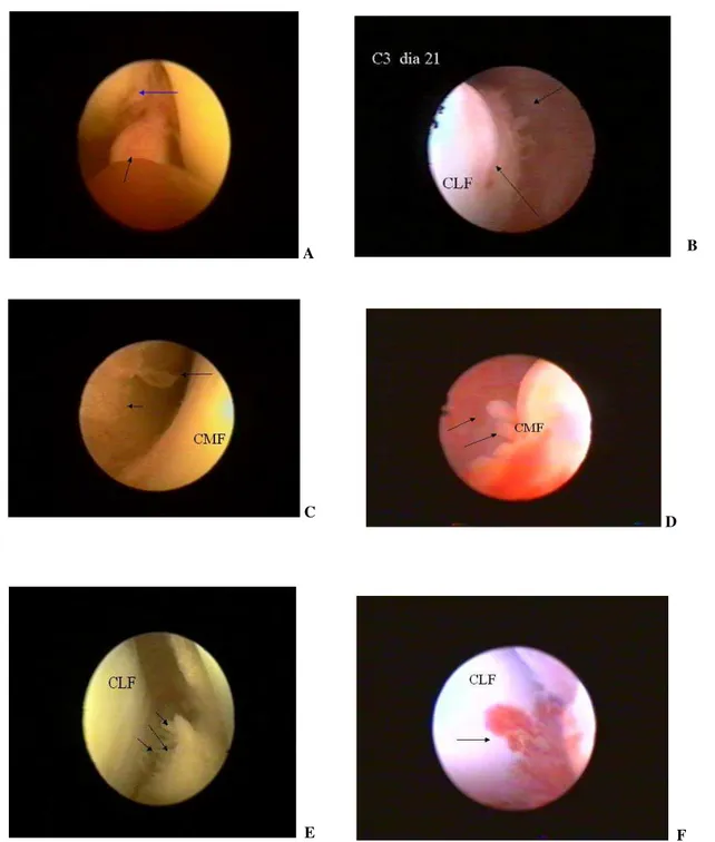 Figura 4. Fotografias das imagens artroscópicas da articulação fêmoro-tíbio-patelar 21 dias após  secção experimental  do LCCr guiada por vídeo-artroscopia