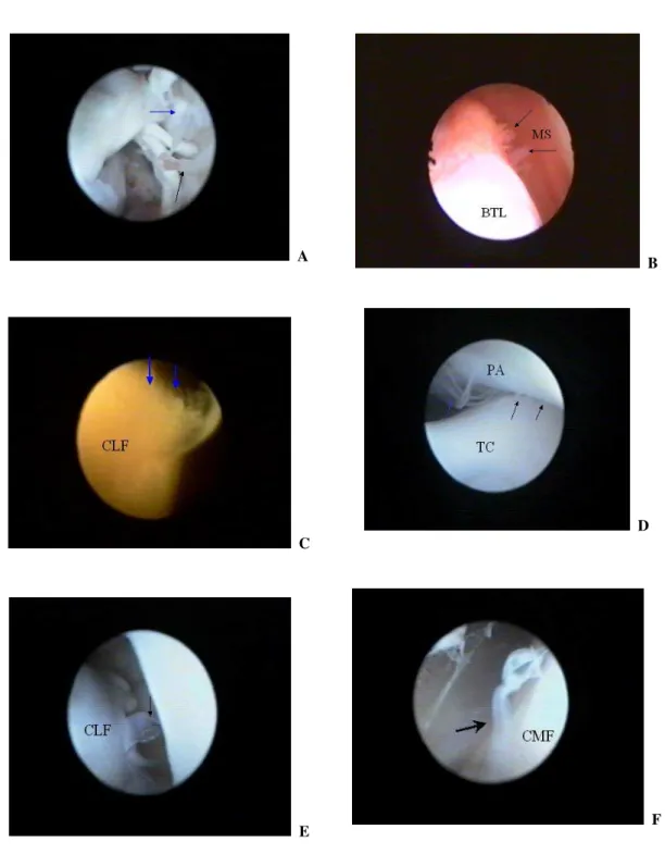 Figura 5. Fotografias das imagens artroscópicas da articulação fêmoro-tíbio-patelar 21 dias após secção experimental  do LCCr guiada por vídeo-artroscopia