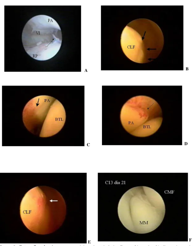 Figura 6. Fotografias das i magens artroscópicas da articulação fêmoro-tíbio-patelar 21 dias após secção  experimental do LCCr guiada por vídeo-artroscopia A) Recesso patelar (RP) com vascularização e fibrina (seta), Patela  (PA) com vilosidades (VI) atrof
