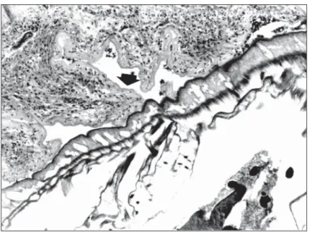 Fig. 3 — A complete desquamation of the intestinal epithelium of Prochilodus lineatus infected with Neoechinorhynchus curemai