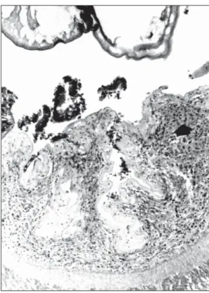 Fig. 5 — Inflammatory reaction at the submucosa associ- associ-ated with oedema and mononuclear and eosinophilic  infil-tration of the intestinal epithelium of Prochilodus lineatus infected with Neoechinorhynchus curemai