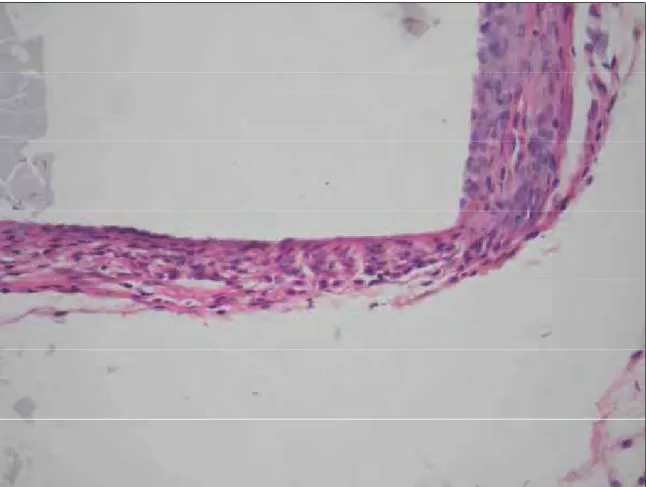 Figura 1. Grupo 30 dias Controle – Observar pequena espessura da cápsula fibrosa, com poucas células inflamatórias crônicas de forma semelhante à cápsula da lateral do tubo (H
