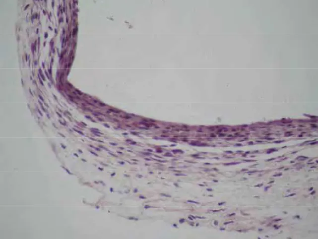 Figura 3. Grupo 30 dias MTA Ângelus® Cinza – Observar pequena espessura da cápsula fibrosa, com poucas células inflamatórias crônicas de forma semelhante à cápsula da lateral do tubo (H