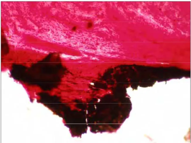 Figura 4. Grupo 30 dias MTA Ângelus® Cinza – Observar presença de áreas de mineralização coradas em negro (Van Kossa, 25X).