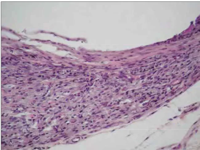 Figura 5. Grupo 30 dias MTA Experimental Fotopolimerizavél – Observar maior espessura da cápsula fibrosa, com poucas células inflamatórias crônicas de forma semelhante à cápsula da lateral do tubo (H