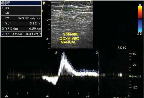 Figura 15 - Imagem do MD mostrando a medida de volume do refluxo na VSM, em  região de CM, em compressão e descompressão manual 