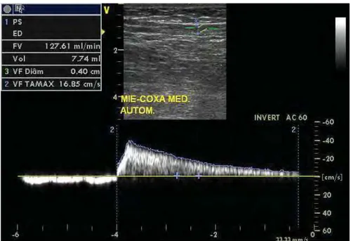 Figura 17 - Imagem do MD mostrando a medida de volume do refluxo na VSM, em  região de CM, em compressão automática 