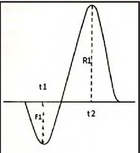 Figura 26 - Desenho esquemático mostrando o refluxo na veia safena magna visto pela  curva espectral