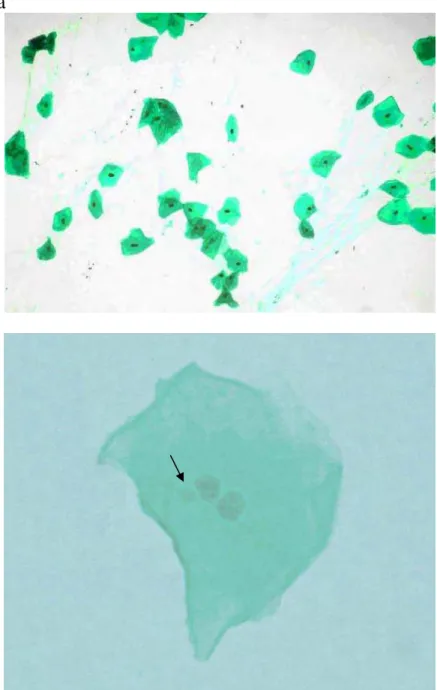 Figura 6:  Apresentação das células do grupo CAPSAD a) Esfregaço mostrando  células coradas pelo método Feulgen,  com citoplasma verde e núcleo  acastanhado (aumento original de 200x); b) Célula binucleada com  apenas 01 MN (aumento original de 1000x).